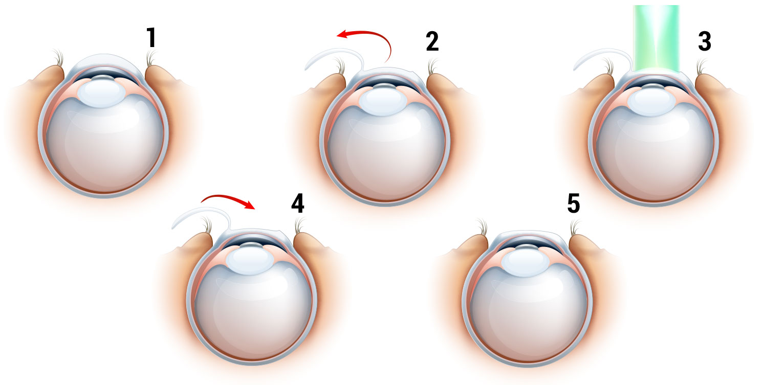 Brillenfreiheit – Laserbehandlung